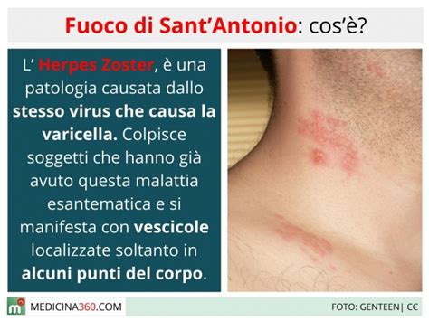 fuoco di sant'antonio è contagioso.